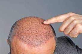 Tips On Choosing A Professional Hair Transplant Clinic
